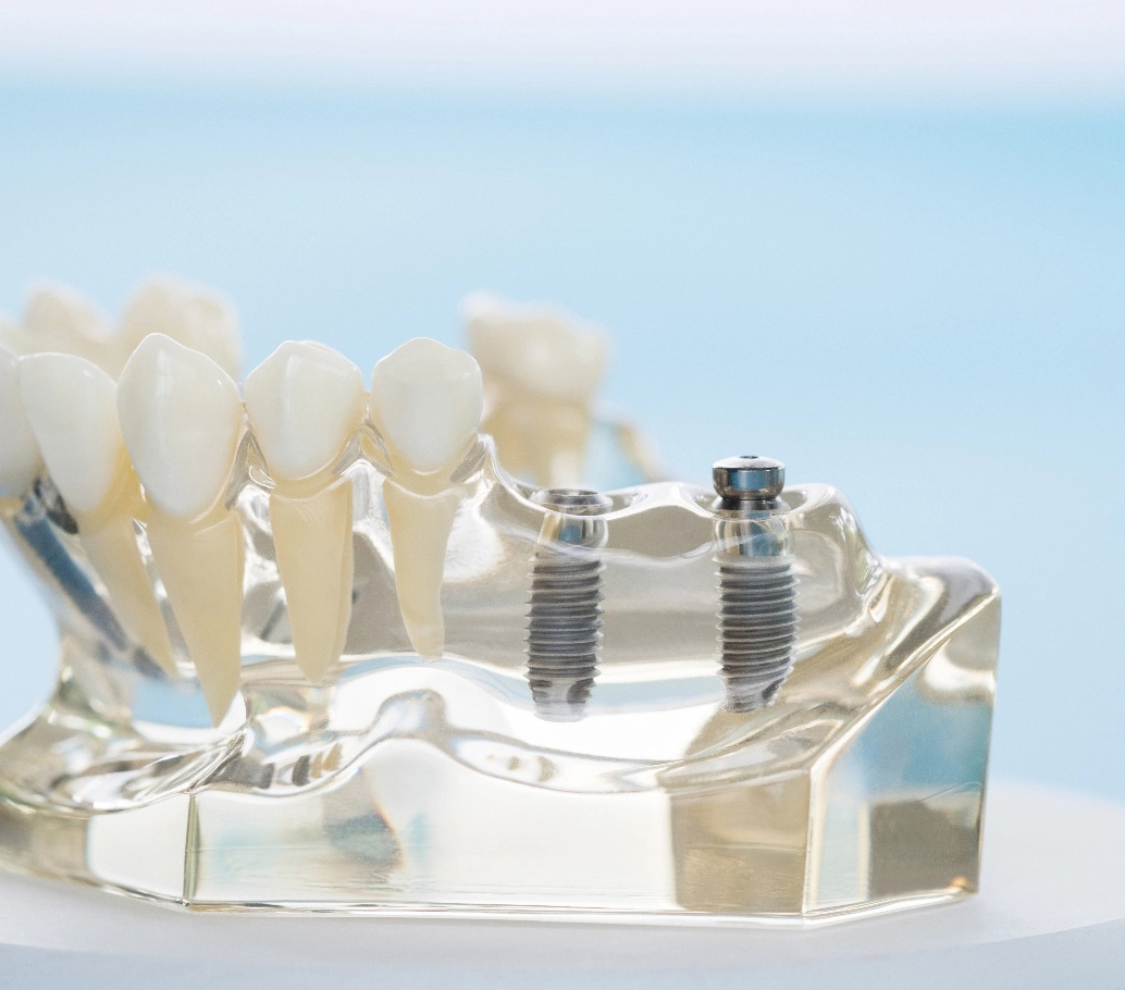 Fogsor minta és implantáció
