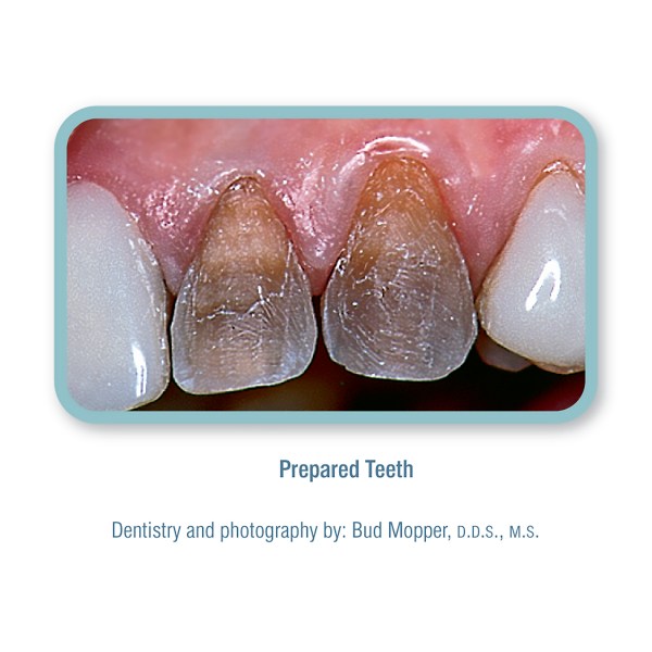 PO2_Pink_Opaque_PrepTeeth_RGB_1800px_1800px